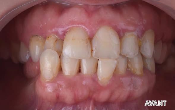 Before treatment smile
