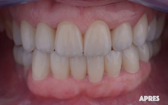 After treatment smile