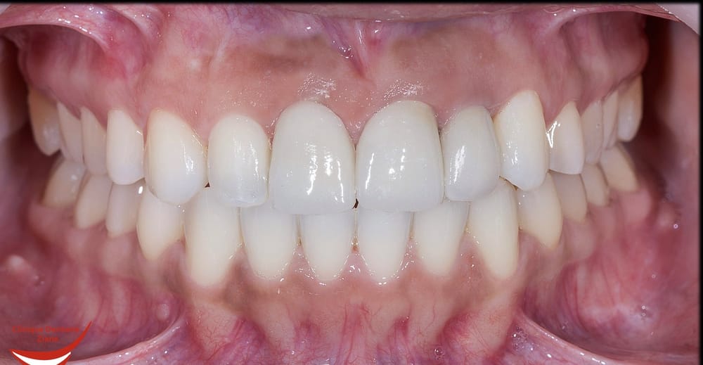 After treatment smile