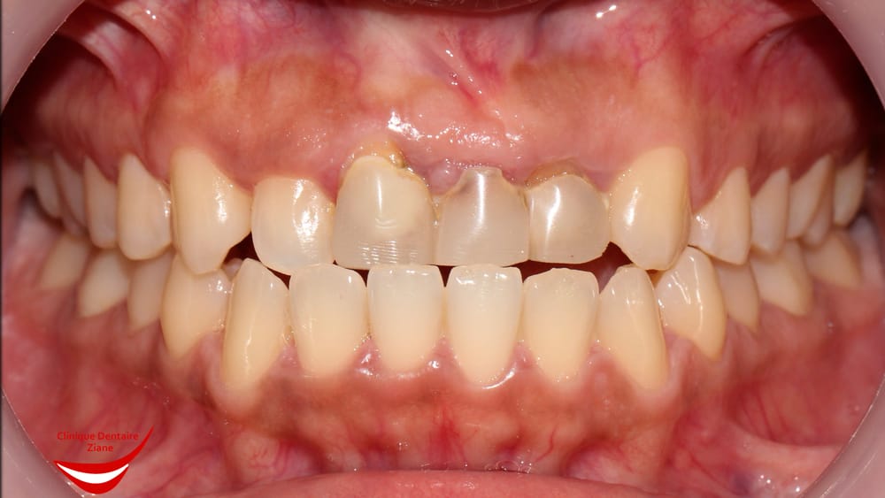 Before treatment smile