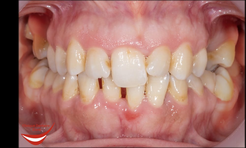 Before treatment smile