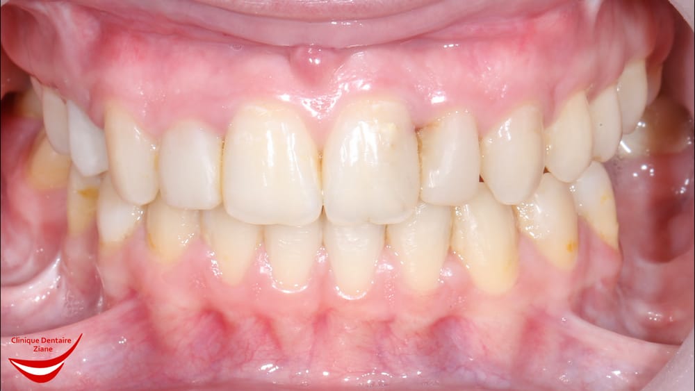After treatment smile