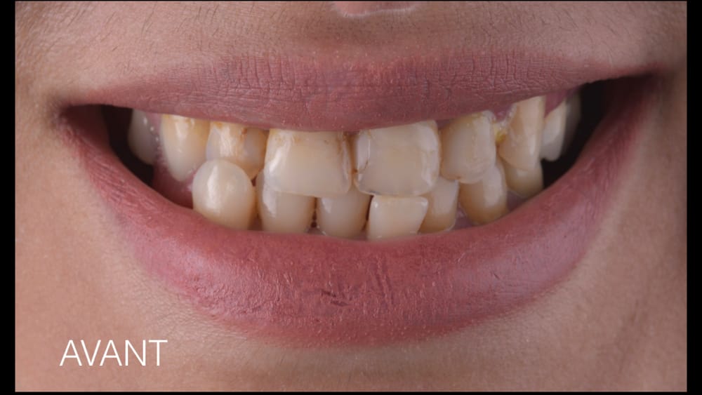 Before treatment smile
