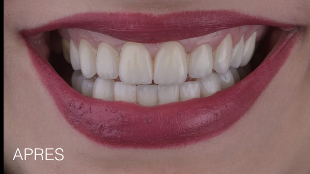 After treatment smile