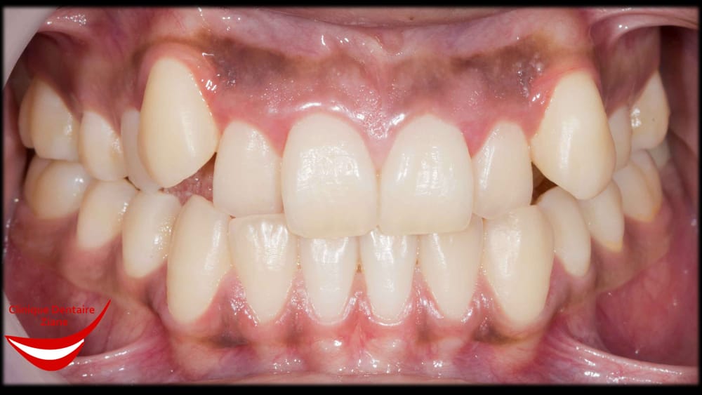 Before treatment smile