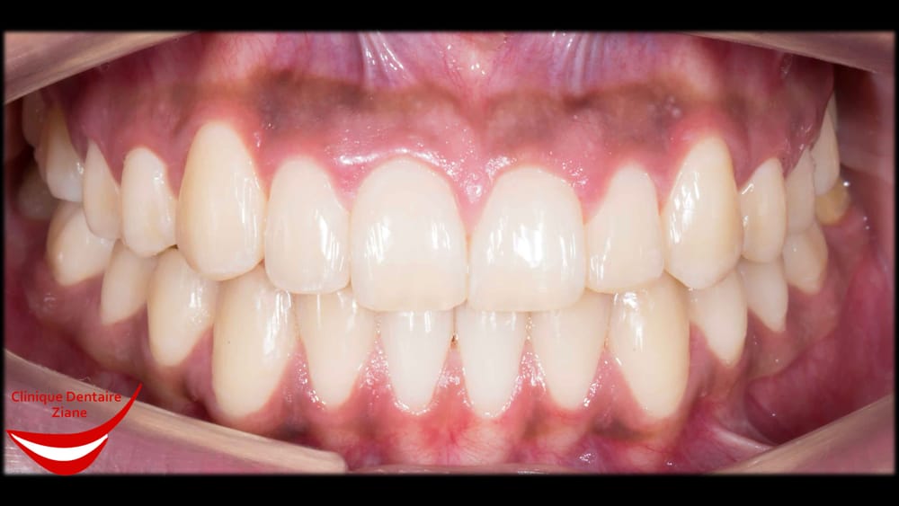 After treatment smile
