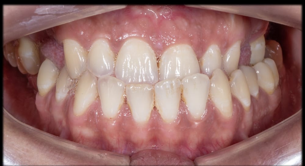 Before treatment smile