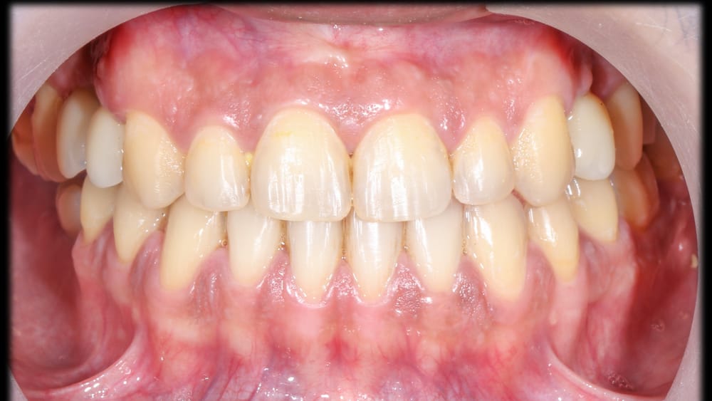 After treatment smile
