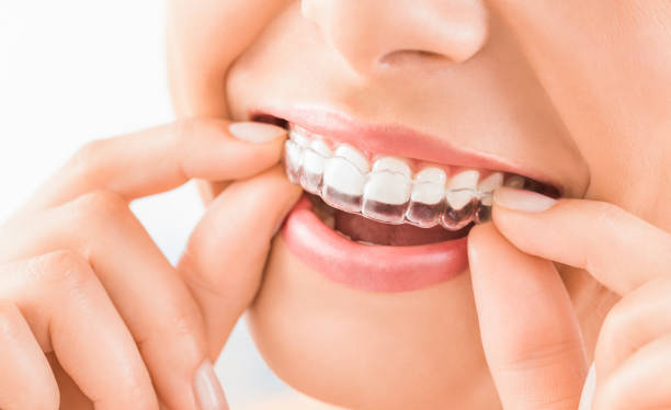 Orthodontie invisible