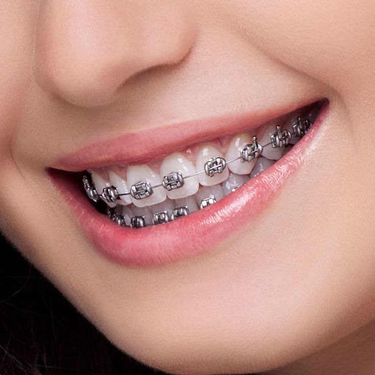Orthodontie classique