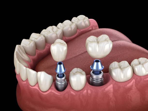 Implant dentaire